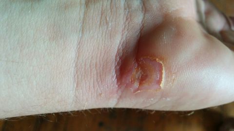 Medihoney Wound Gel Manuka